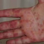 انفلونزا الطماطم